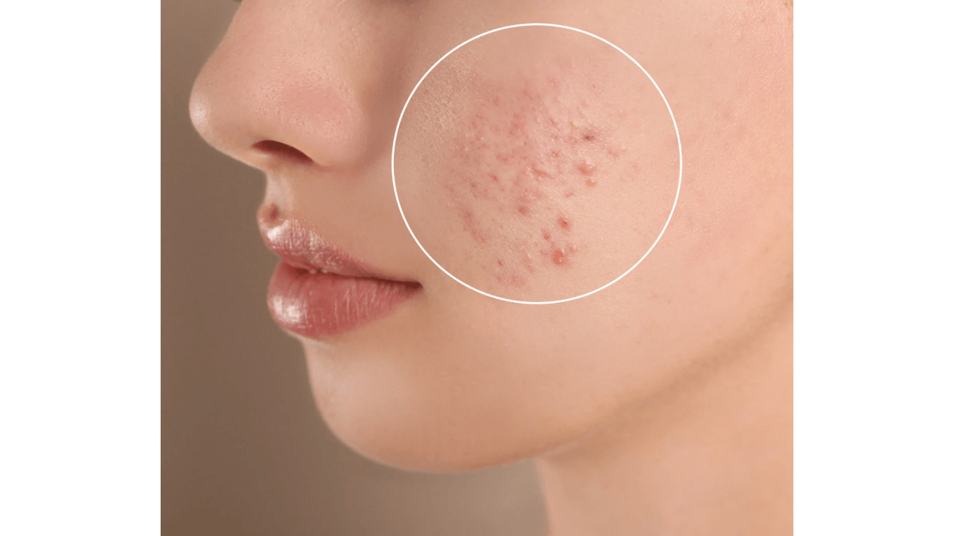 Jugend-Akne bei Teenagern